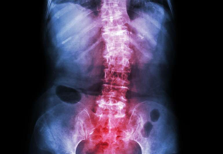 Chiropractic Help for Scoliosis