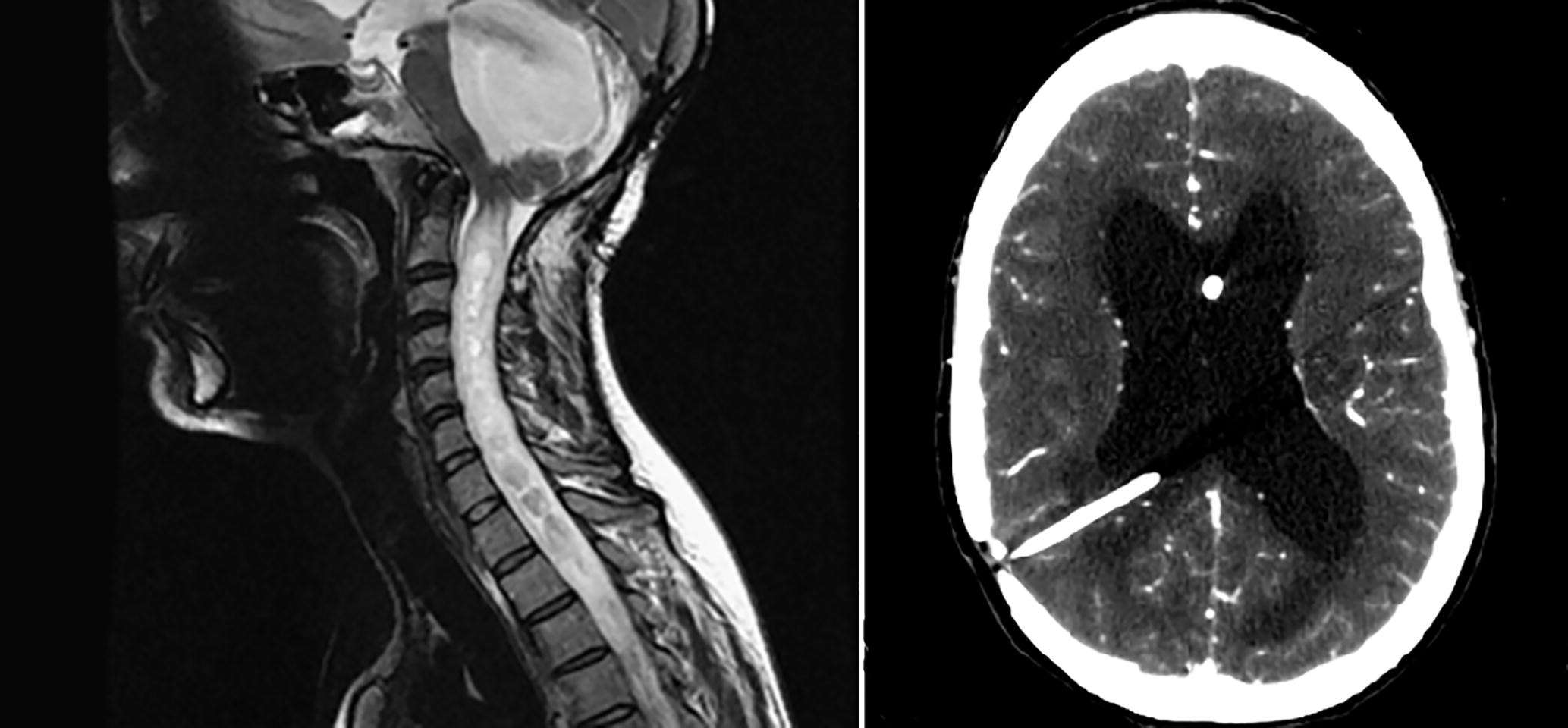 Tethered Cord Syndrome Care: A Comprehensive Overview